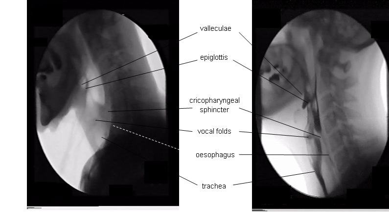 head and neck from video stills